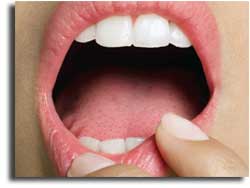 Tumore della bocca Introduzione - Bocca aperta